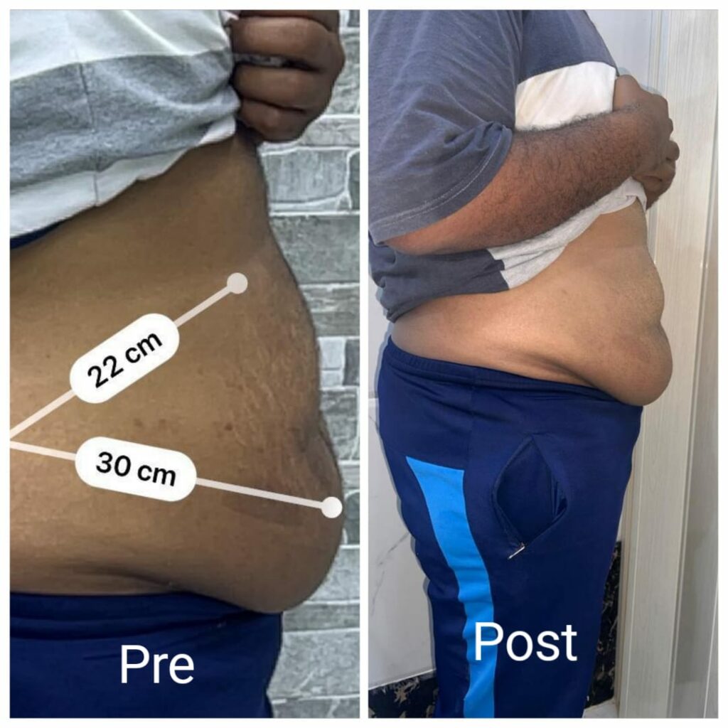 أفضل نتيجة مع أفضل دكتور تفتيت دهون في مركز نضارة